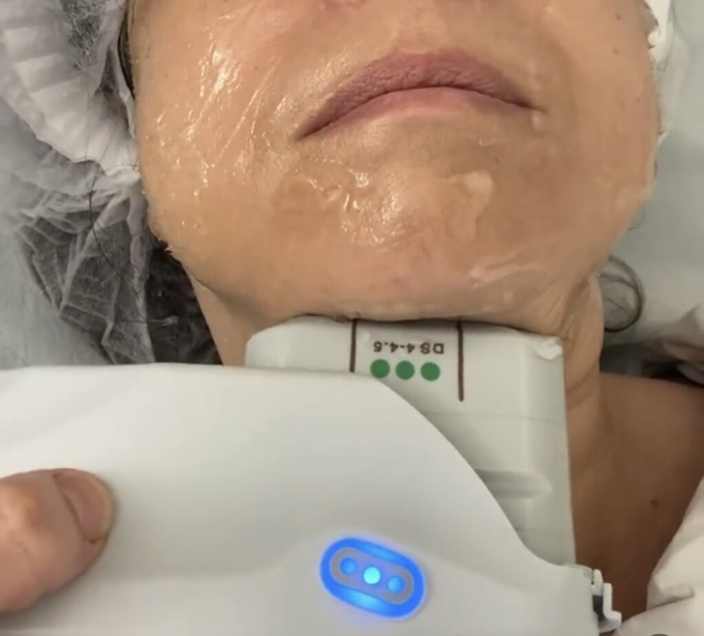 Hifu facial