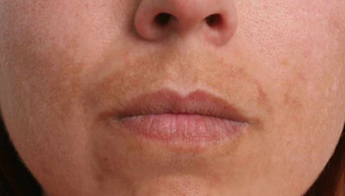 Melasma en labio